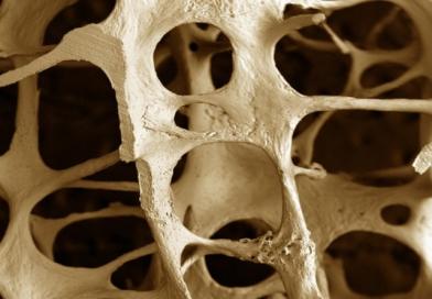 Kako se liječi osteoporoza