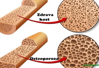 osteoporoza